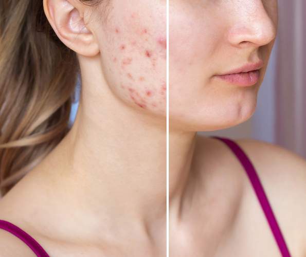 BBL forever clear acne treatment near me in Florida.