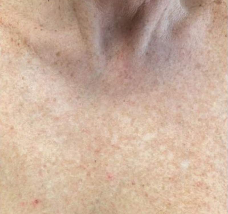 bbl skin rejuvination before (2)
