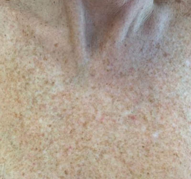 bbl skin rejuvination before